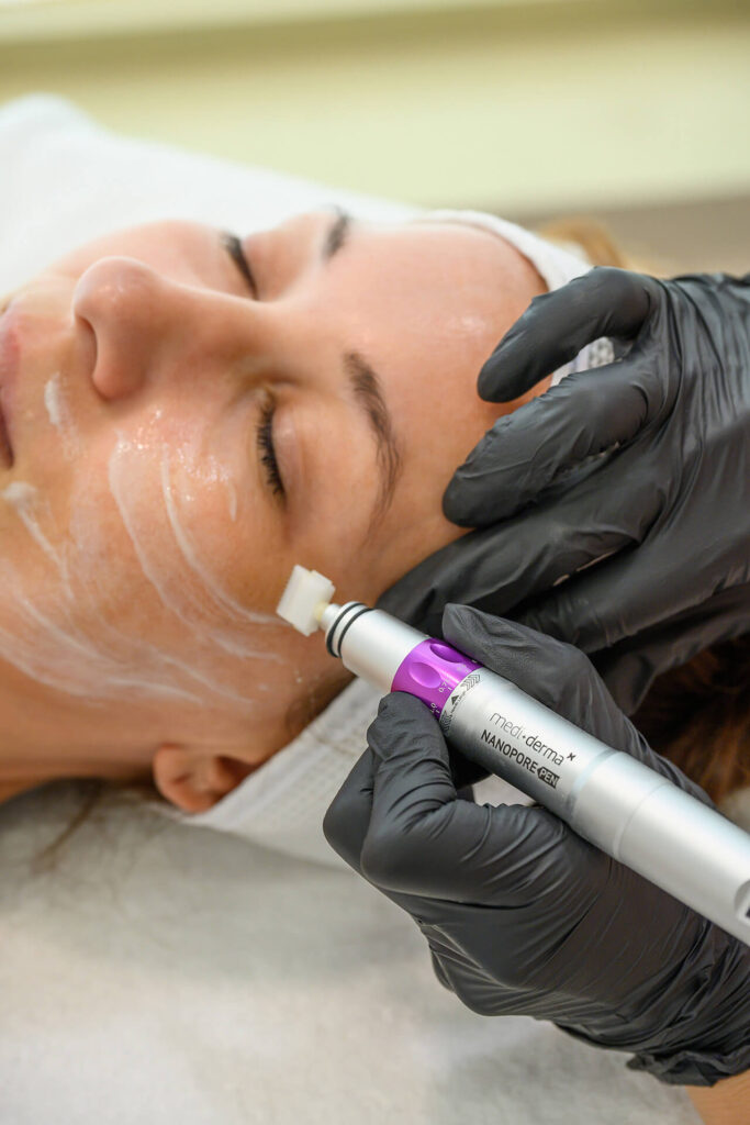 Θεραπεία Microneedling (Micro Pen) για ανάπλαση προσώπου και ουλές ακμής στο κέντρο αισθητικής Skin Lux στο Περιστέρι.