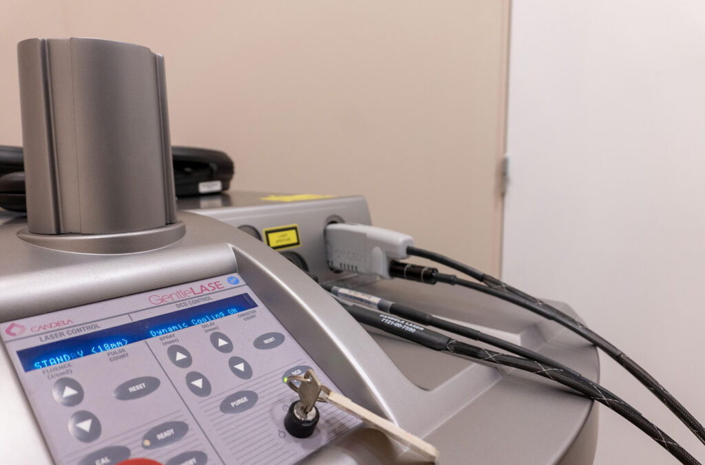 Το μηχάνημα laser Αλεξανδρίτη Candela, τεχνολογία αιχμής για αποτρίχωση, στο ινστιτούτο αισθητικής Skin Lux στο Περιστέρι.