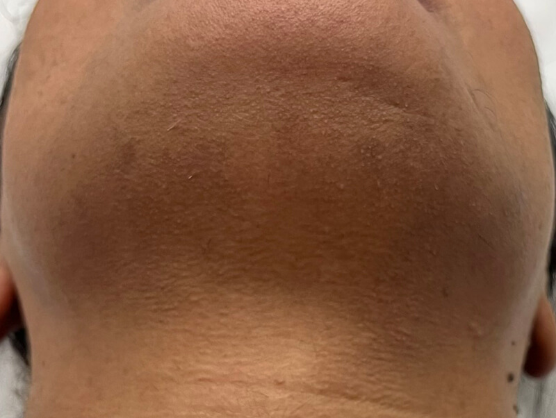 Αποτέλεσμα Laser Candela κάτω από το πηγούνι. Το δέρμα είναι καθαρό, λείο και χωρίς ερεθισμούς ή σκιές από τρίχες.