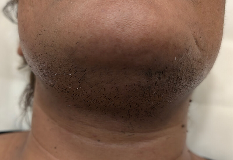 Έντονη ορμονική τριχοφυΐα και σημάδια θυλακίτιδας στην περιοχή κάτω από το πηγούνι (λαιμός) πριν την έναρξη Laser Alexandrite στο Skin Lux.