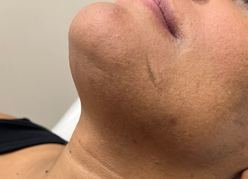 Τελικό αποτέλεσμα μόνιμης αποτρίχωσης σε πλάγια λήψη προσώπου. Πλήρης εξάλειψη τριχοφυΐας στο πλάι του πηγουνιού με Candela Alexandrite.