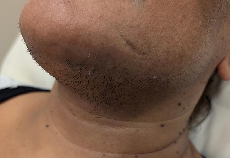 Πλαϊνή όψη γυναικείου προσώπου με ανεπιθύμητη τριχοφυΐα κατά μήκος του πηγουνιού και στο μάγουλο πριν τη θεραπεία.